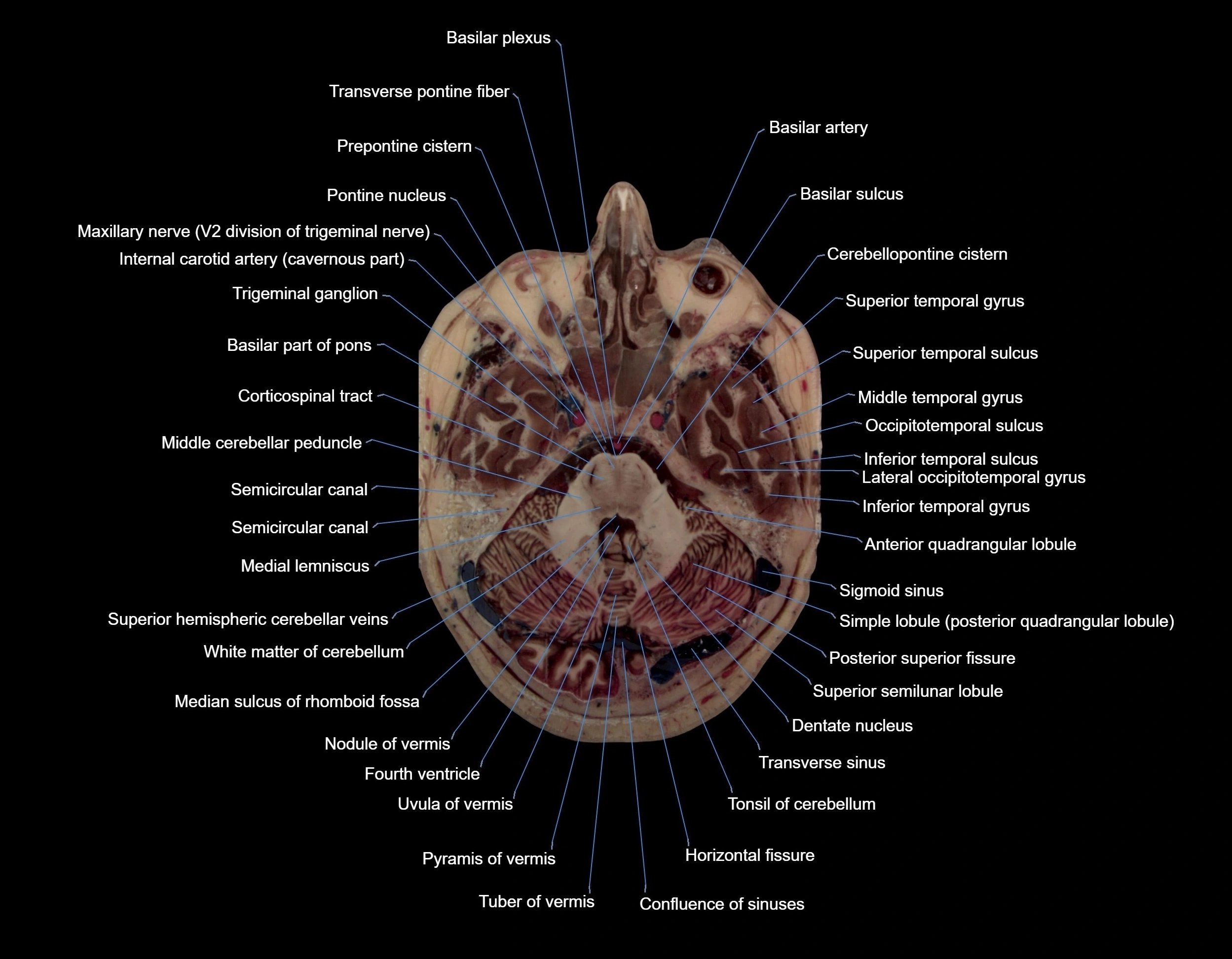 MRI Brain axial cross sectional radiology anatomy 3T image  -img-000022.webp
